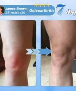 EQVP™ Nano-Microneedle Joint Patch