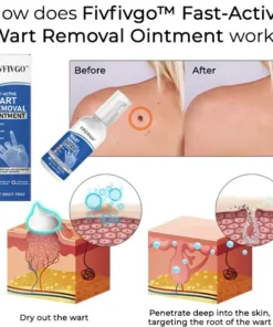 Fivfivgo™ Fast-Active Wart Removal Ointment