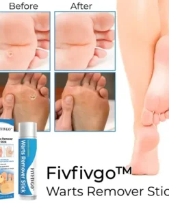 Fivfivgo® Warts Remover Stick
