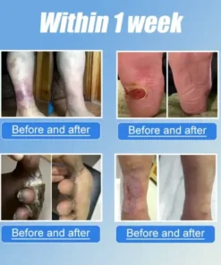 JORONDY® VitaGluco Diabetes Treatment Cream