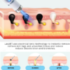 LAOZIK® Non-Invasive Mole and Wart Removal Laser Pen