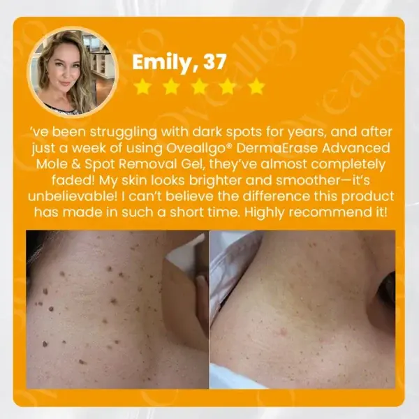 Oveallgo® DermaErase Mole adhartach & Gel toirt air falbh spot