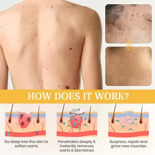 Oveallgo® DermaErase Mole adhartach & Gel toirt air falbh spot