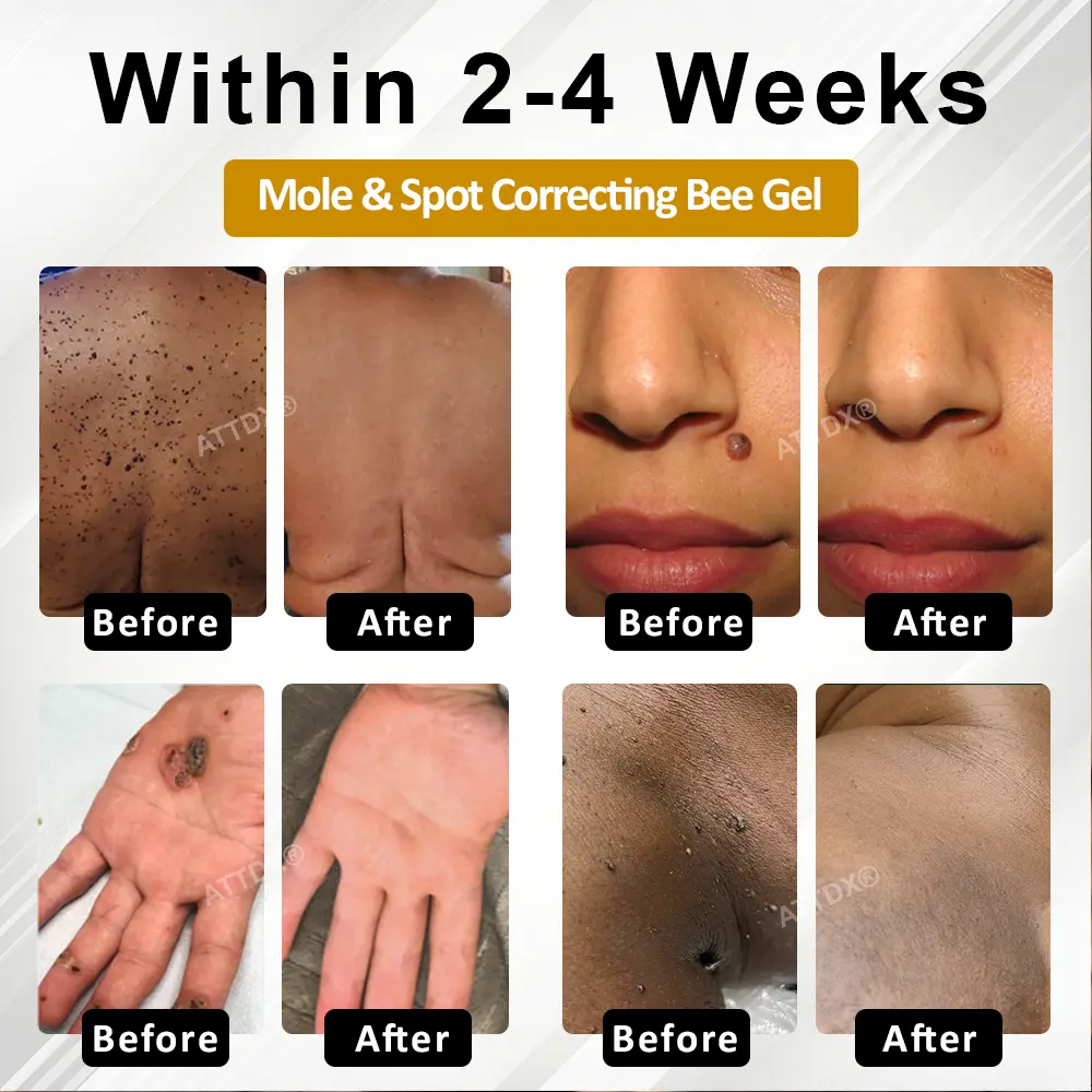 ATTDX® Advanced Mole & Spot Correcting Bee Gel