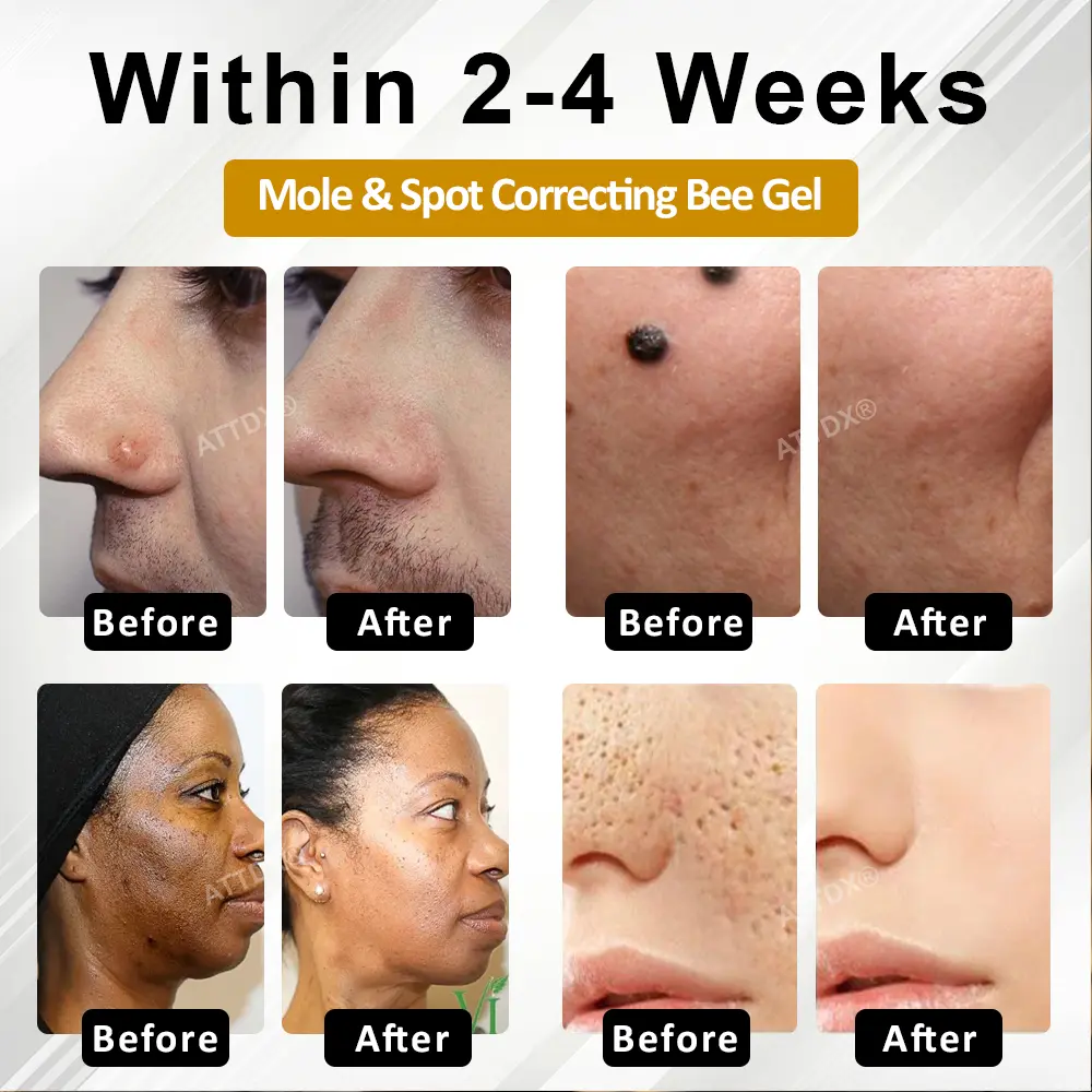 ATTDX® Advanced Mole & Spot Correcting Bee Gel