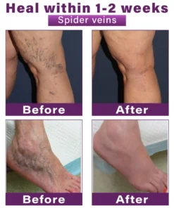 ✅GFOUK® Polidocanol Nano Varicose Vein Patch👩🏼‍⚕️Recognised by the Australasian College of Phlebology