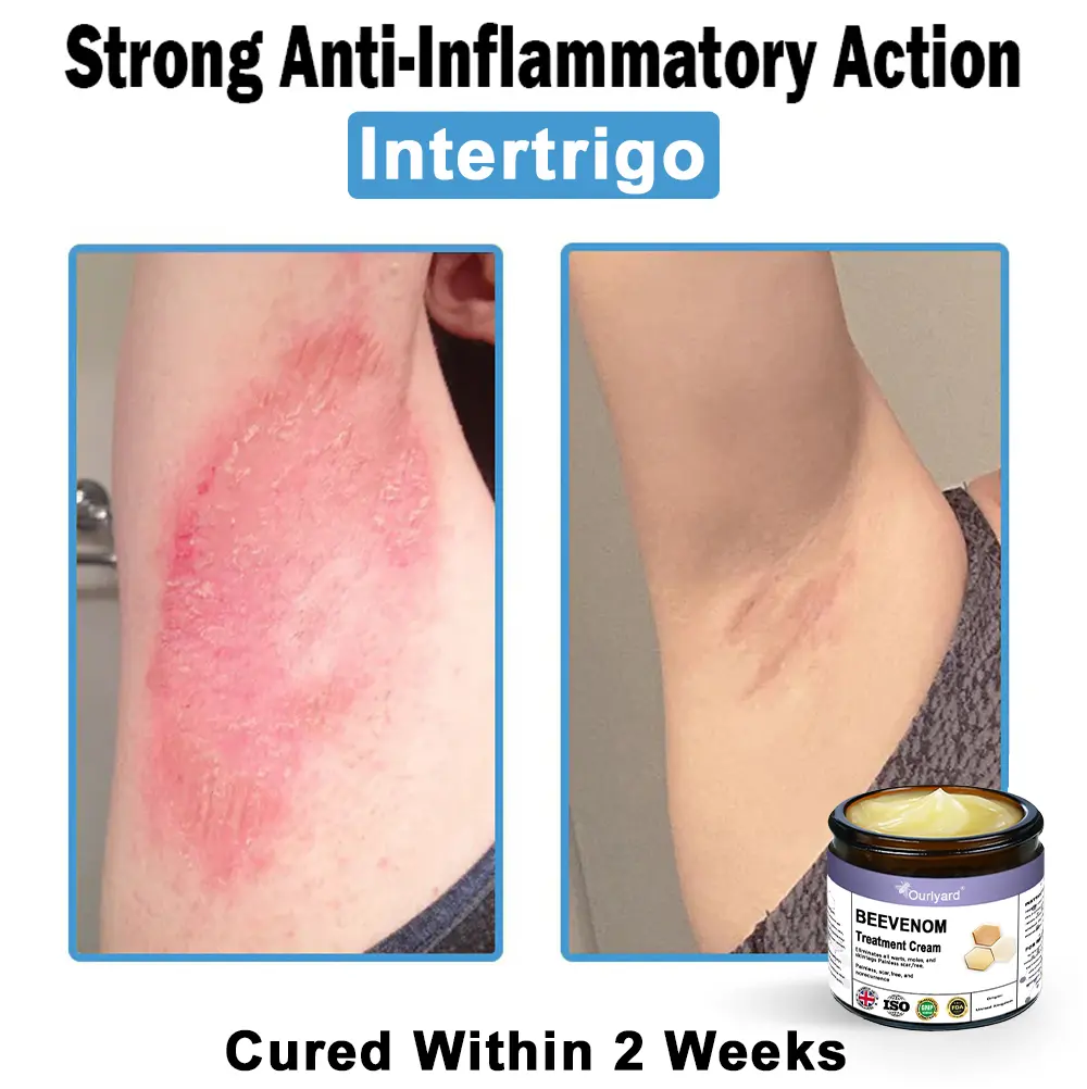 Ourlyard® Bee Venom Skin Treatment Cream