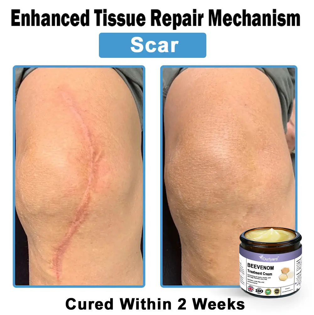 Ourlyard® Bee Venom Skin Treatment Cream