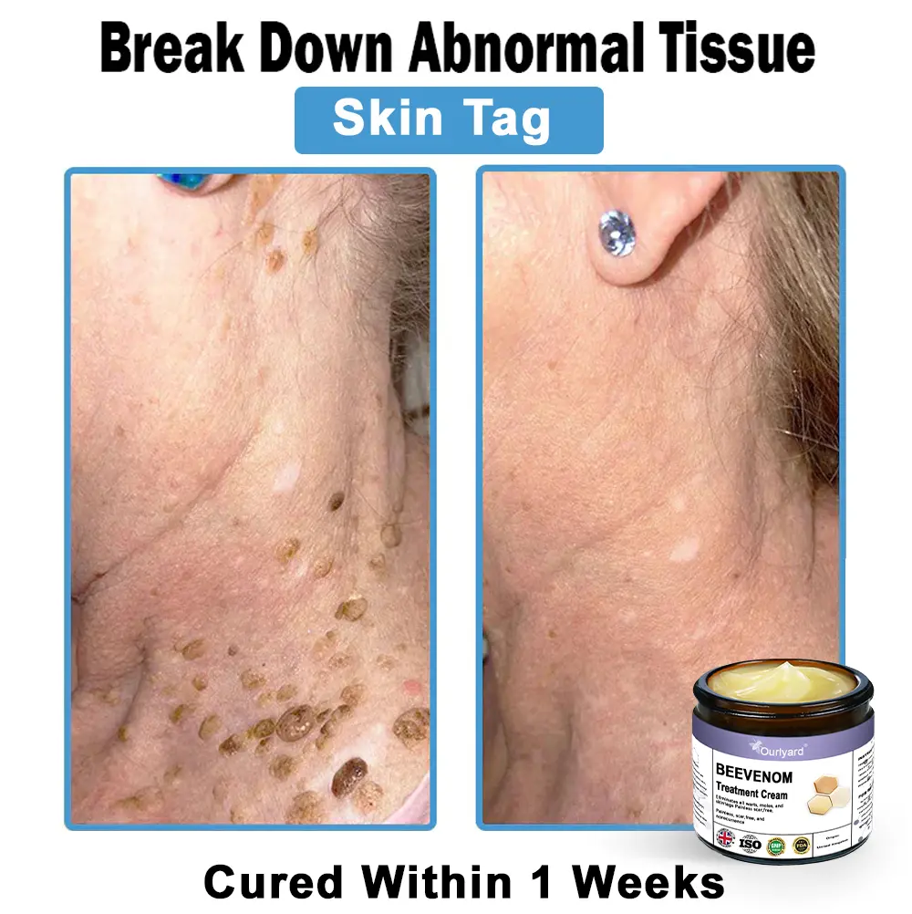 Ourlyard® Bee Venom Skin Treatment Cream