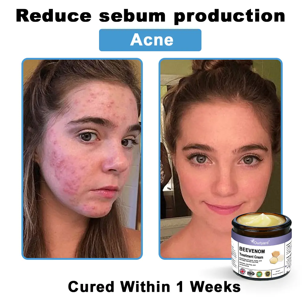 Ourlyard® Bee Venom Skin Treatment Cream