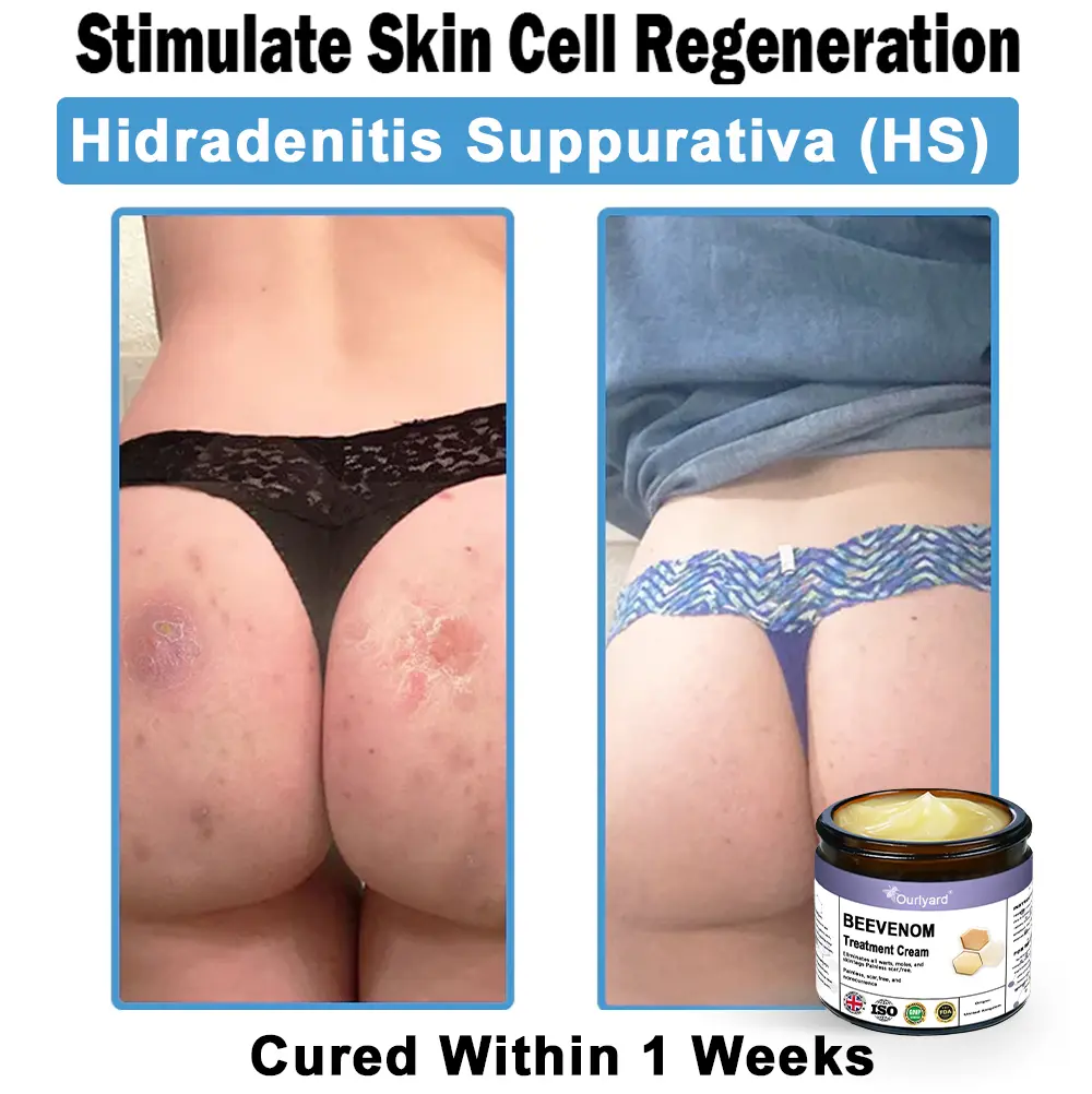 Ourlyard® Bee Venom Skin Treatment Cream