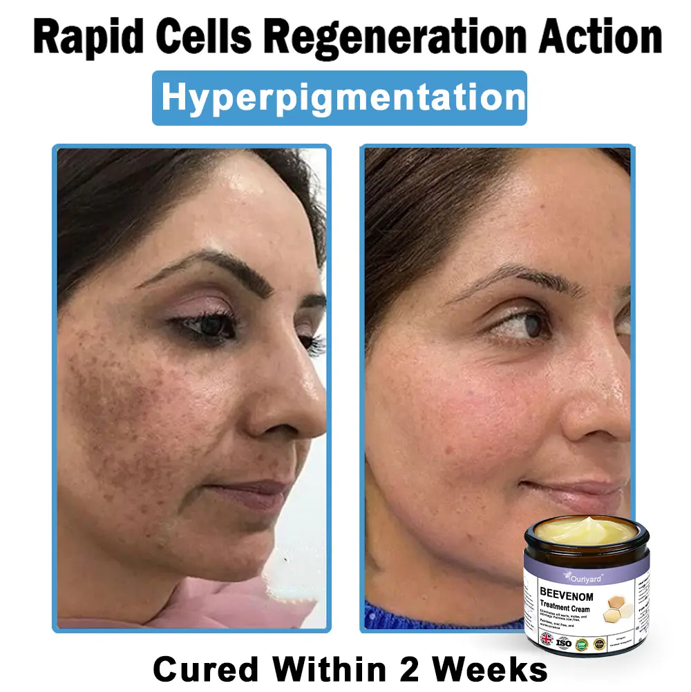 Ourlyard® Bee Venom Skin Treatment Cream