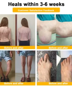 🍎Ourlyard® Botulinum Toxin & 𝐁𝐞𝐞 𝐕𝐞𝐧𝐨𝐦 𝐏𝐚𝐢𝐧 𝐑𝐞𝐥𝐢𝐞𝐟 & 𝐁𝐨𝐧𝐞 𝐇𝐞𝐚𝐥𝐢𝐧𝐠 𝐃𝐮𝐚𝐥 𝐀𝐜𝐭𝐢𝐨𝐧 𝐒𝐨𝐨𝐭𝐡𝐢𝐧𝐠 𝐂𝐫𝐞𝐚𝐦 (AAOS Recommended)