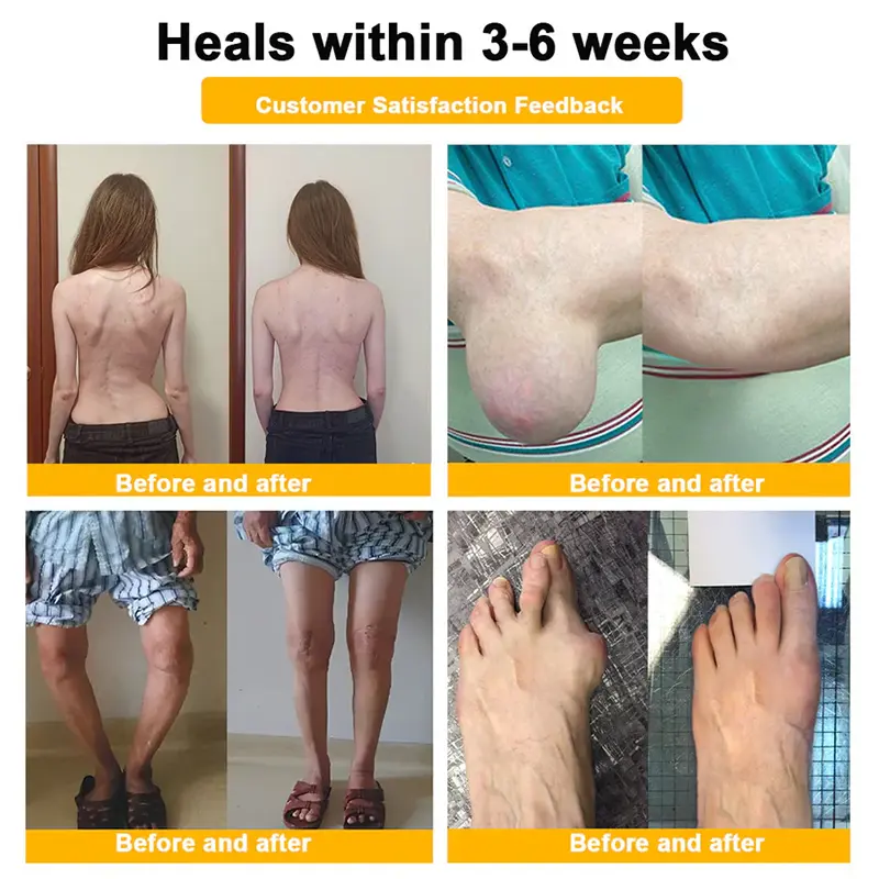 ๐Ourlyardยฎ Botulinum Toxin & ๐๐๐ ๐๐๐ง๐จ๐ฆ ๐๐๐ข๐ง ๐๐๐ฅ๐ข๐๐ & ๐๐จ๐ง๐ ๐๐๐๐ฅ๐ข๐ง๐ ๐๐ฎ๐๐ฅ ๐๐๐ญ๐ข๐จ๐ง ๐๐จ๐จ๐ญ๐ก๐ข๐ง๐ ๐๐ซ๐๐๐ฆ (AAOS Recommended)