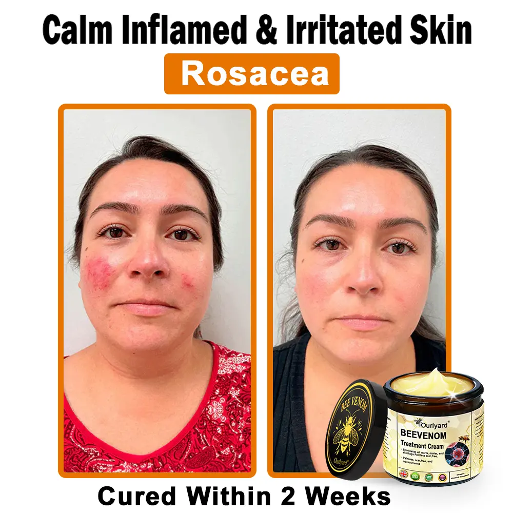 Ourlyard® Botulinum Toxin & Bee Venom Skin Treatment Cream