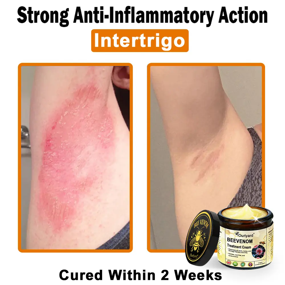 Ourlyard® Botulinum Toxin & Bee Venom Skin Treatment Cream