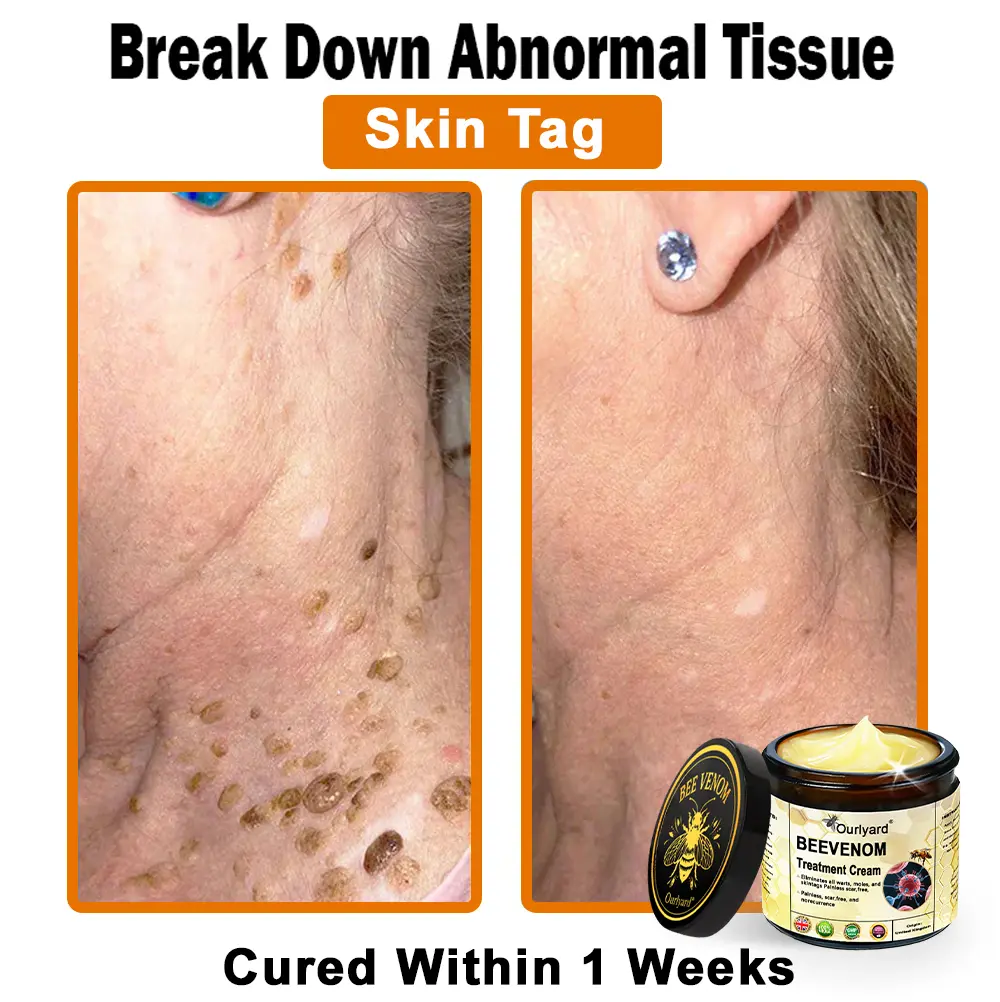 Ourlyard® Botulinum Toxin & Bee Venom Skin Treatment Cream