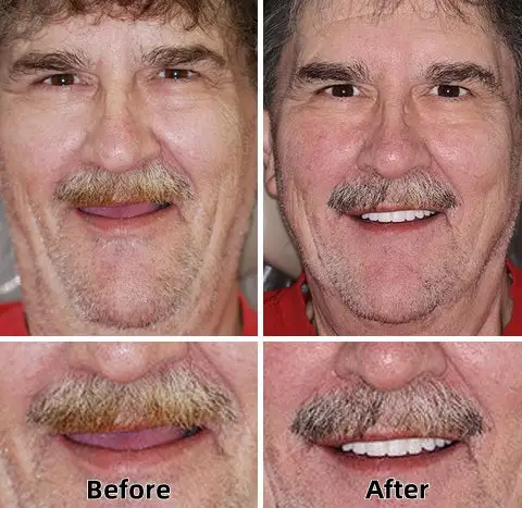 SmileFitPro™ - Napredne funkcionalne proteze po mjeri