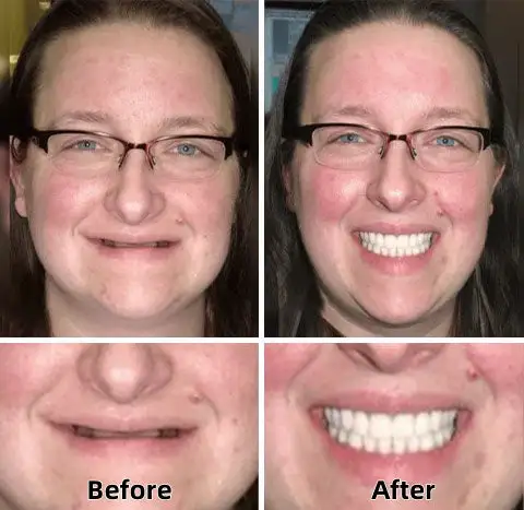 SmileFitPro™ - Napredne funkcionalne proteze po mjeri