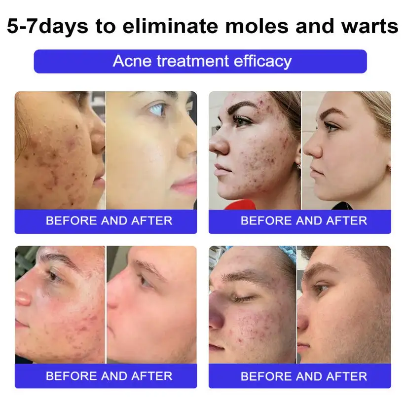 coastglee™ Gentle Care Herbal Acne Cream