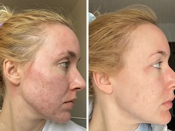 coastglee™ Gentle Care Herbal Acne Cream