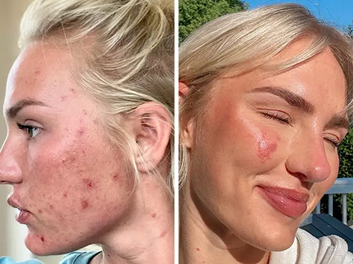 coastglee™ Gentle Care Herbal Acne Cream