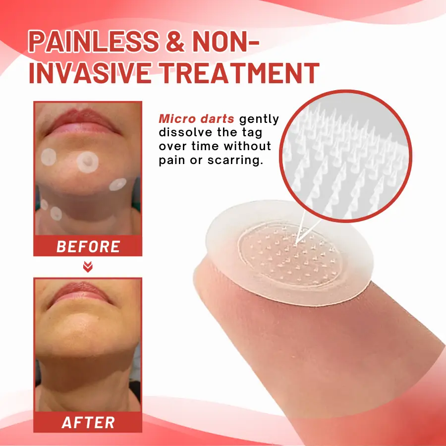 coastglee® MicroDart Skin Tag Remover Patch