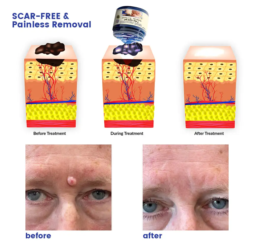 coastglee™7 Day Rapid Wart Removal Gel(U.S. FDA approved)