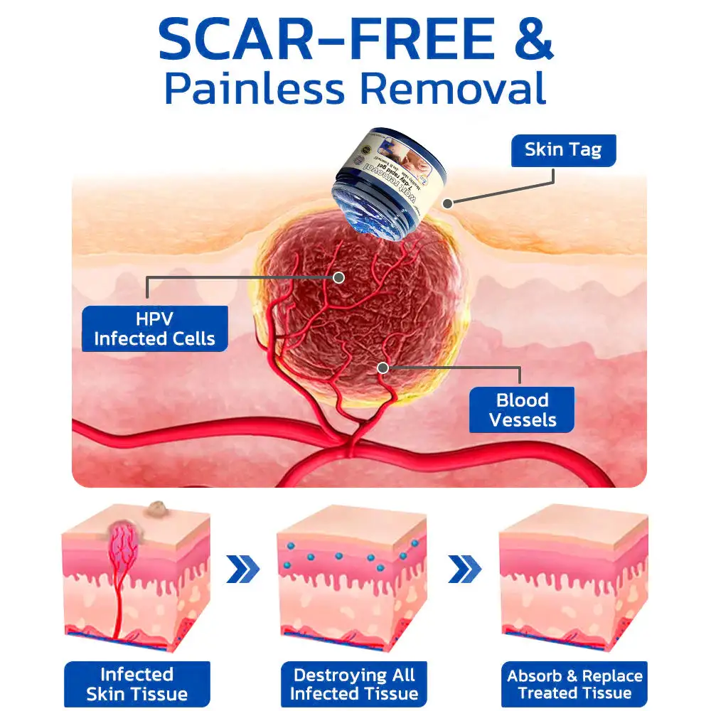coastglee™7 Day Rapid Wart Removal Gel(U.S. FDA approved)
