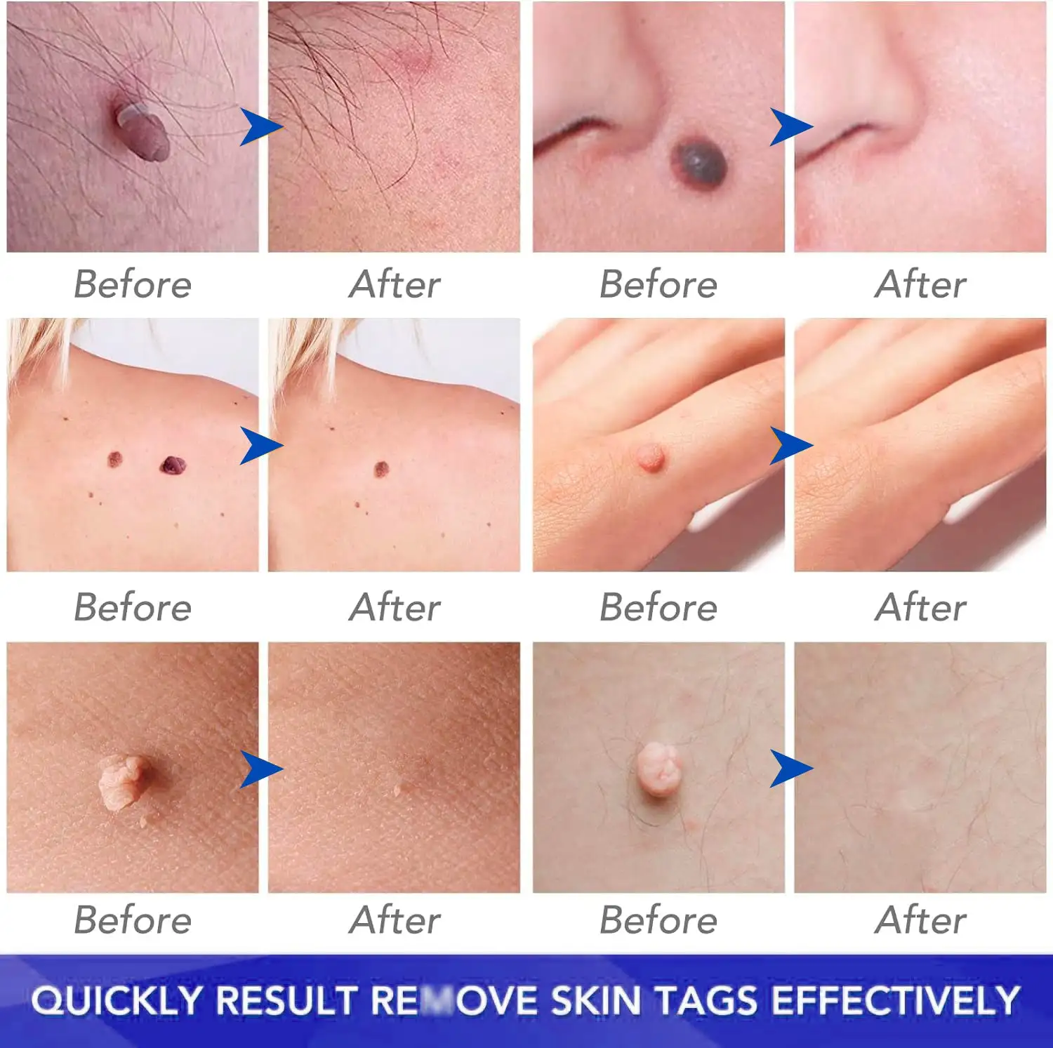 coastglee™7 Day Rapid Wart Removal Gel(U.S. FDA approved)