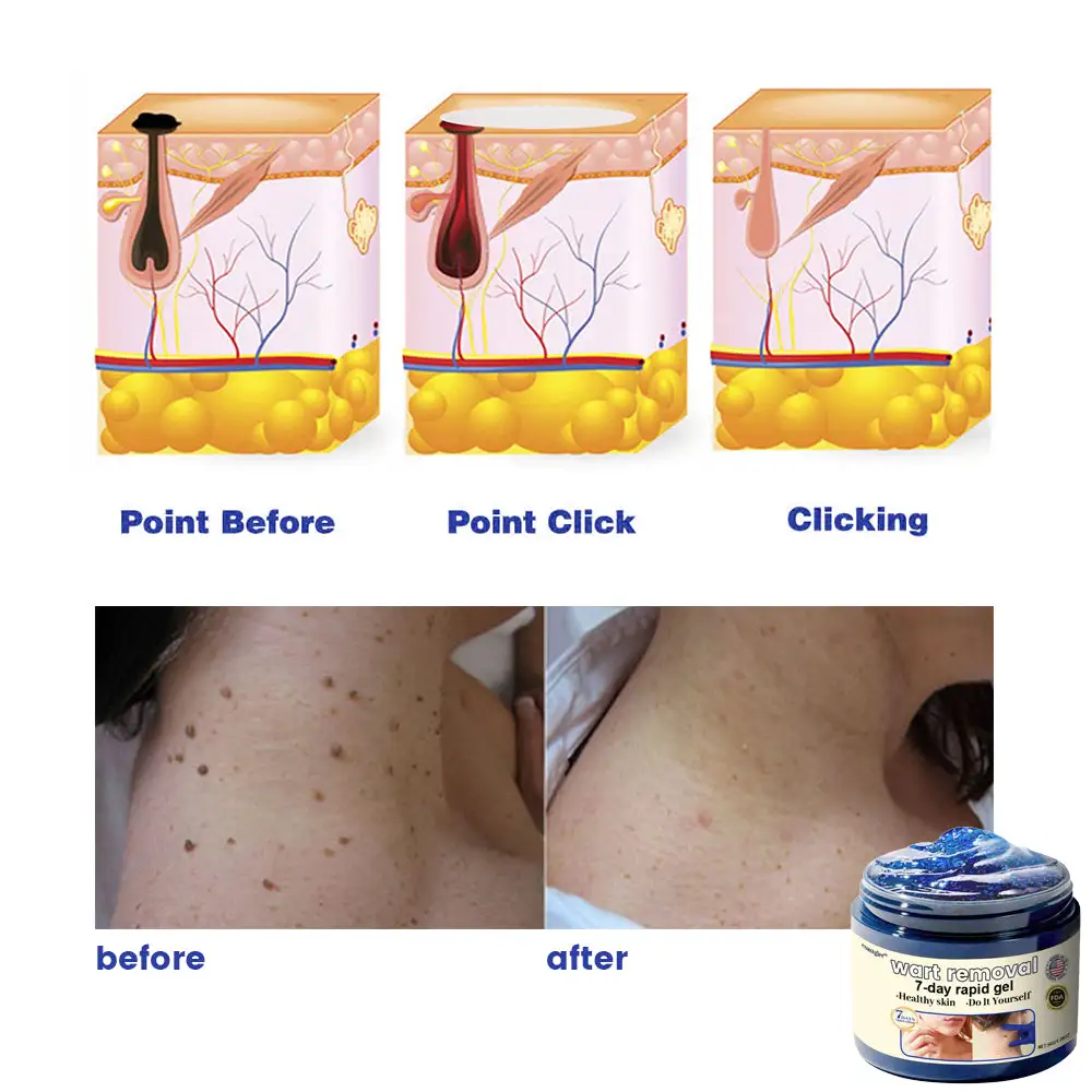 coastglee™7 Day Rapid Wart Removal Gel(U.S. FDA approved)