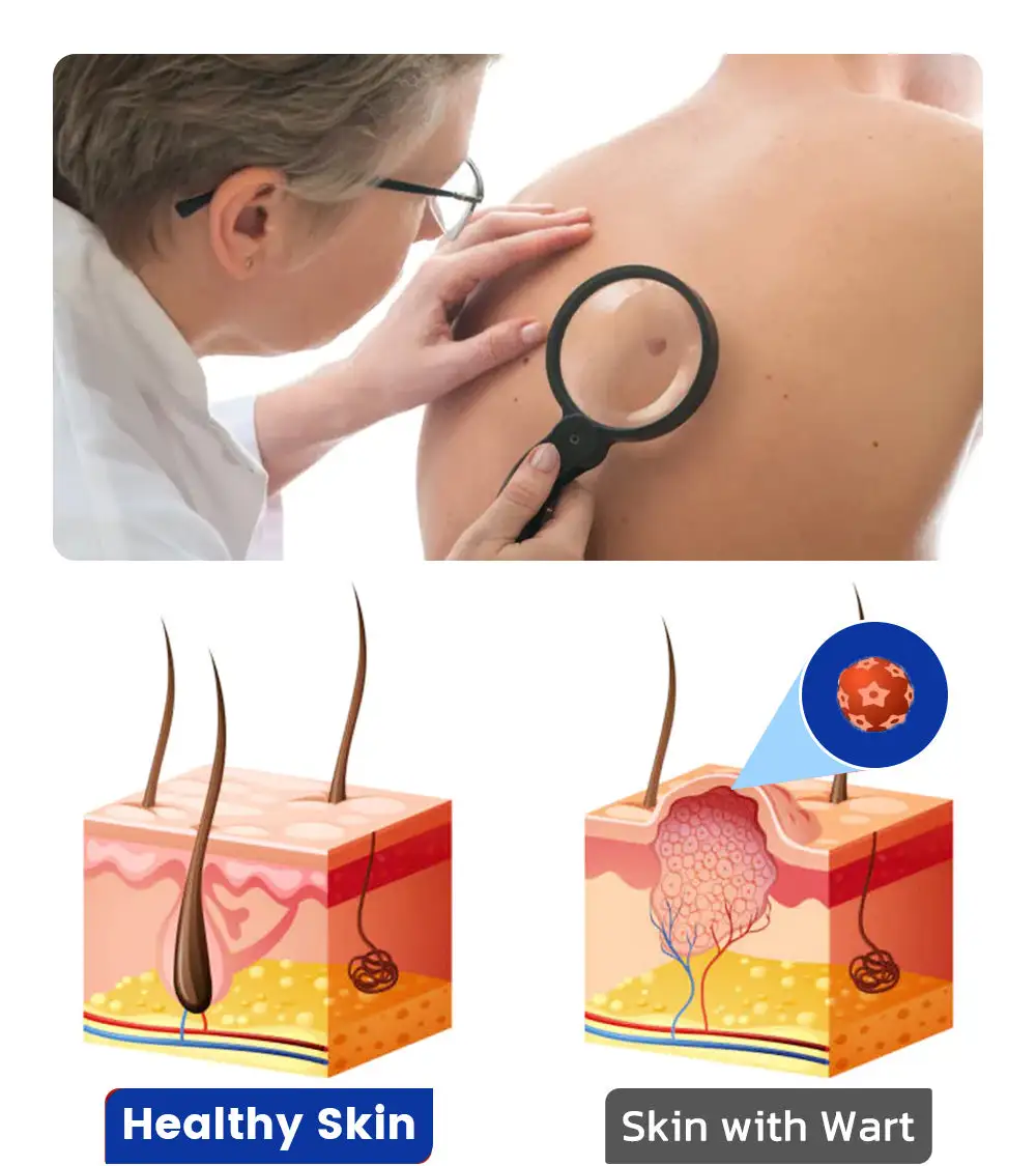 coastglee™7 Day Rapid Wart Removal Gel(U.S. FDA approved)