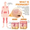 【Official Brand Store】PsoriaHeal Psoriasis Spray Pro
