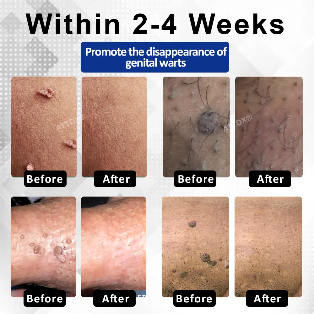 ATTDX® ManGuard HPV Wart Healing Cream