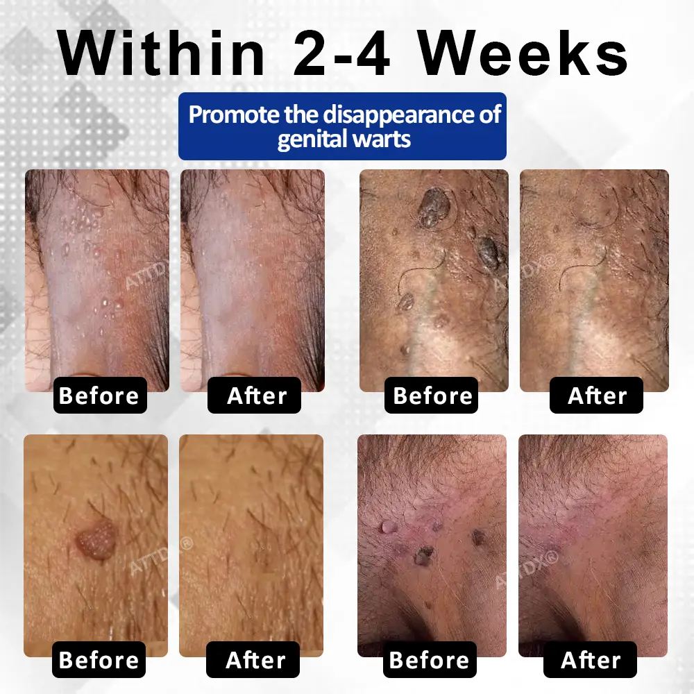 ATTDX® ManGuard HPV Wart Healing Cream
