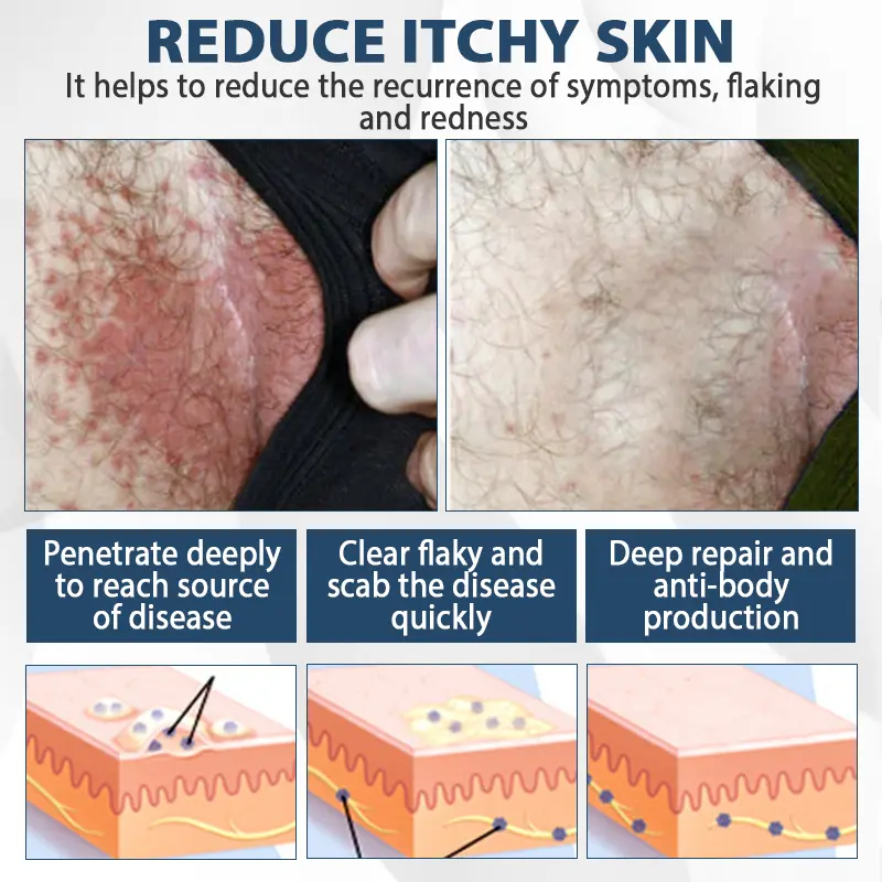 ATTDX® ManGuard HPV Wart Healing Cream