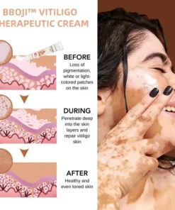 BBOJI™ Vitiligo Therapeutic Cream