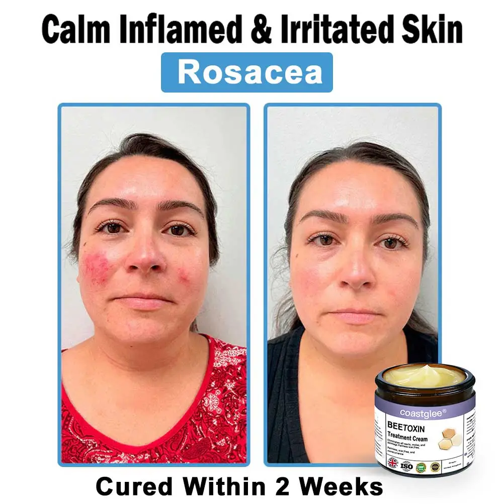 Official Store: coastglee® Bee Toxin Skin Treatment Cream👨⚕️British Academy of Dermatology (BAD) Approved