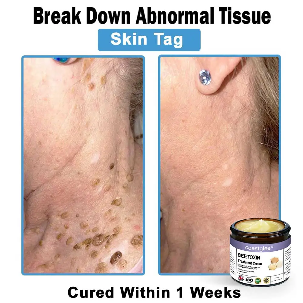 Official Store: coastglee® Bee Toxin Skin Treatment Cream👨⚕️British Academy of Dermatology (BAD) Approved