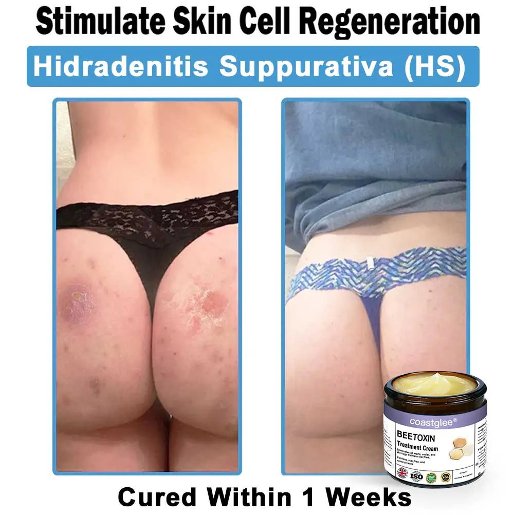 Official Store: coastglee® Bee Toxin Skin Treatment Cream👨⚕️British Academy of Dermatology (BAD) Approved