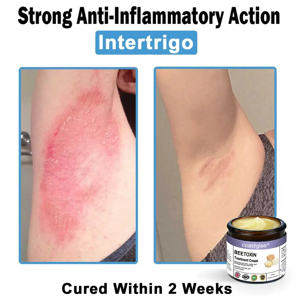 Official Store: coastglee® Bee Toxin Skin Treatment Cream👨⚕️British Academy of Dermatology (BAD) Approved