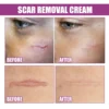 Slimoly™ Scar Removal Cream