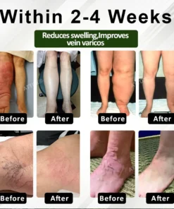 ATTDX® HormoBalance Edema Ear Patch