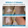 Bikenda® DermaBeam Vitiligo Therapy Device