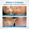 Bikenda® DermaBeam Vitiligo Therapy Device