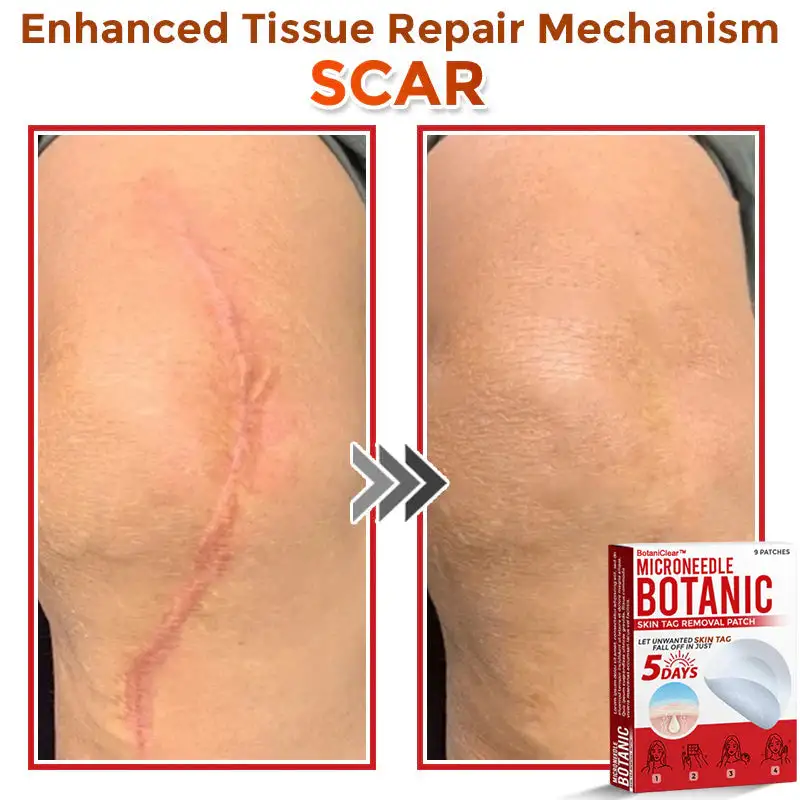 BotaniClear™ USA-Made MicroNeedle Patch
