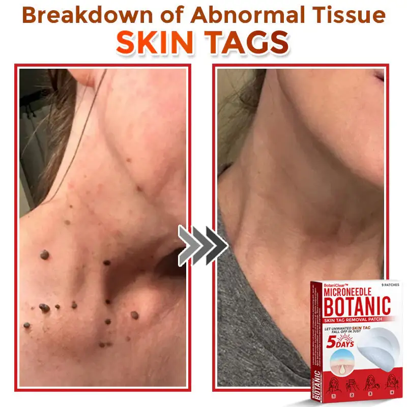 BotaniClear™ USA-Made MicroNeedle Patch