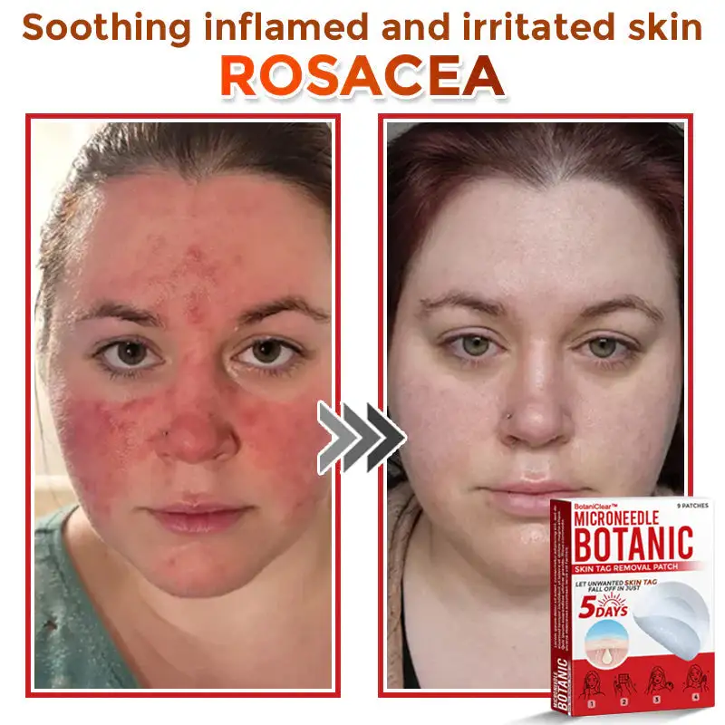 BotaniClear™ USA-Made MicroNeedle Patch