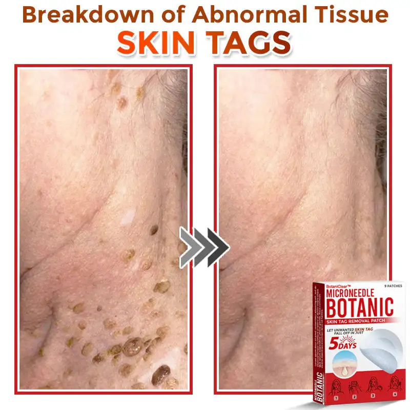 BotaniClear™ USA-Made MicroNeedle Patch