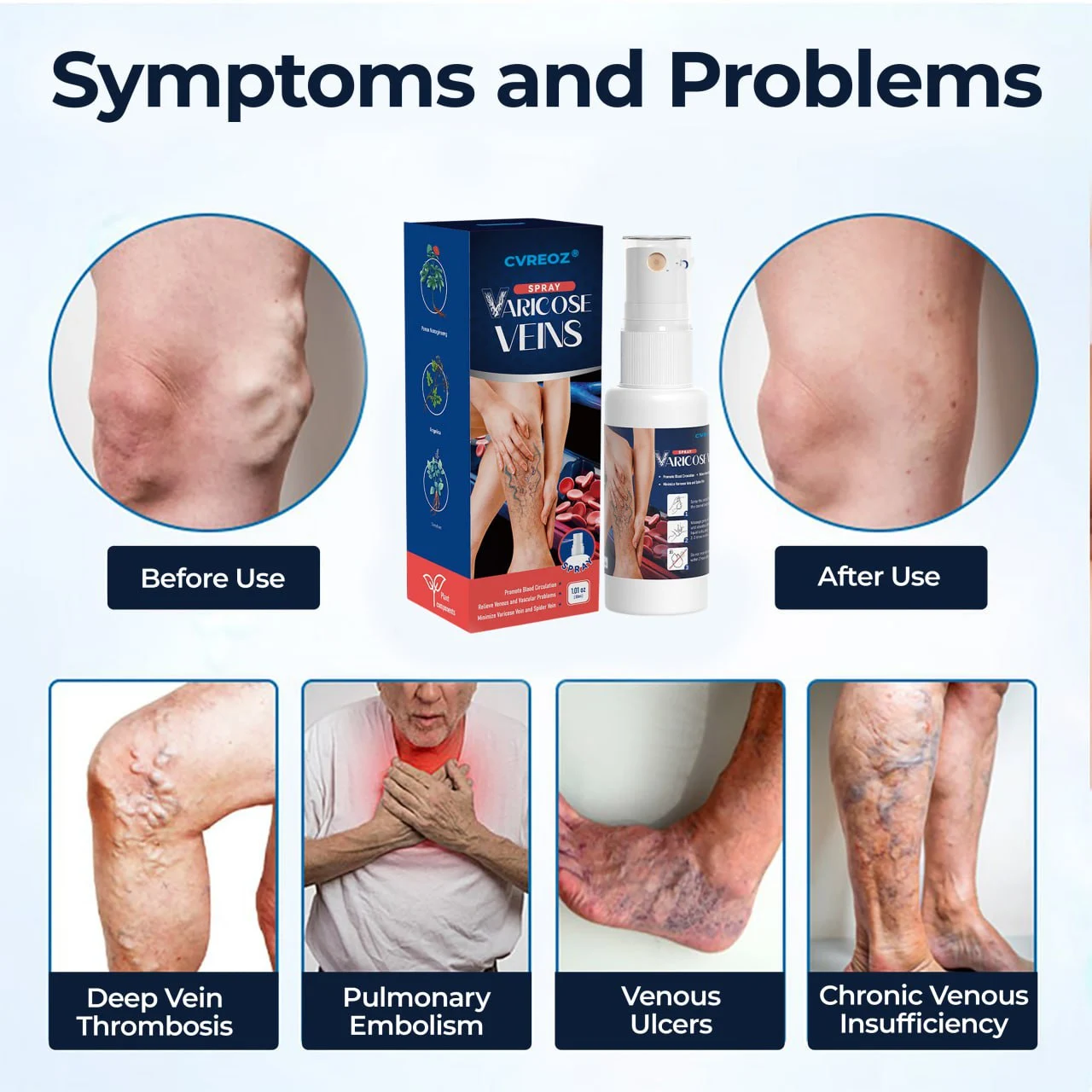 CVREOZ® Varicose Veins Spray